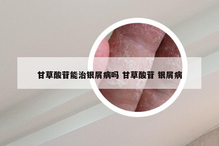 甘草酸苷能治银屑病吗 甘草酸苷 银屑病