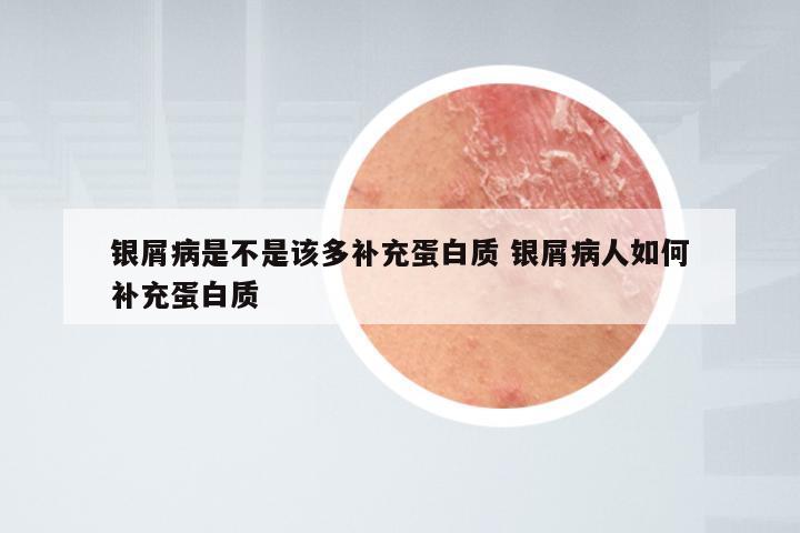 银屑病是不是该多补充蛋白质 银屑病人如何补充蛋白质