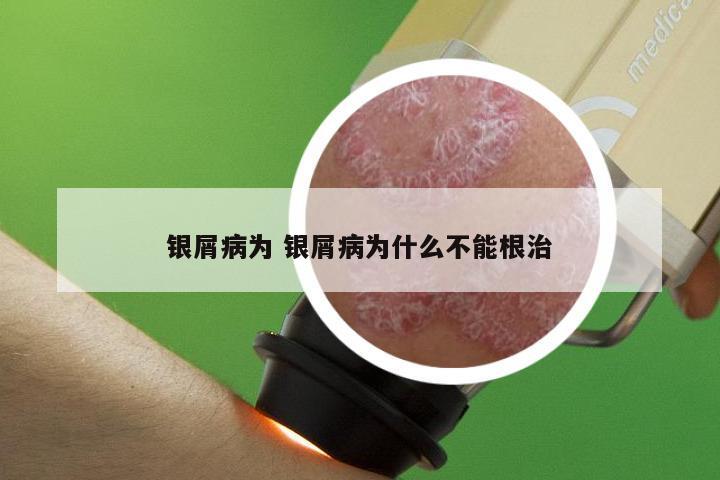 银屑病为 银屑病为什么不能根治