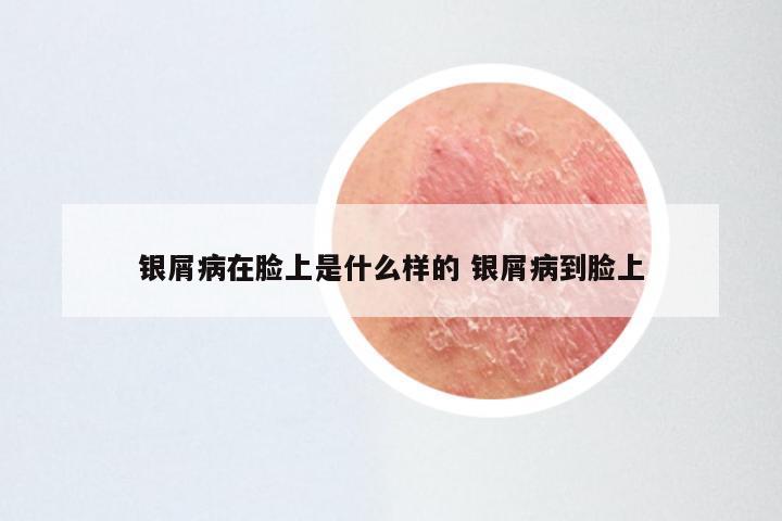 银屑病在脸上是什么样的 银屑病到脸上