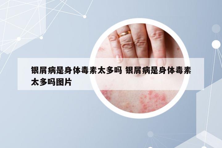 银屑病是身体毒素太多吗 银屑病是身体毒素太多吗图片