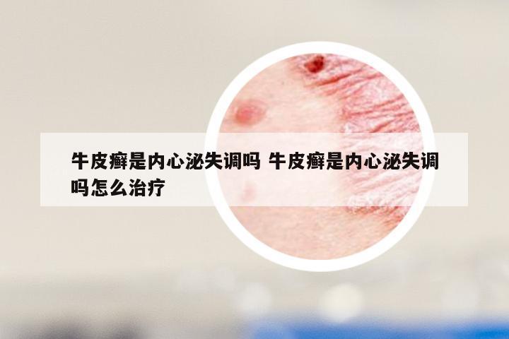 牛皮癣是内心泌失调吗 牛皮癣是内心泌失调吗怎么治疗