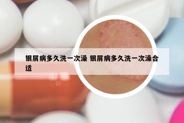 银屑病多久洗一次澡 银屑病多久洗一次澡合适