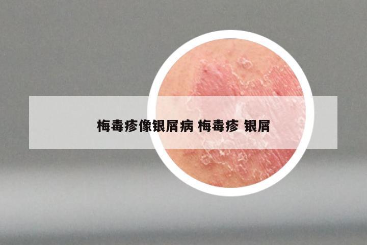 梅毒疹像银屑病 梅毒疹 银屑
