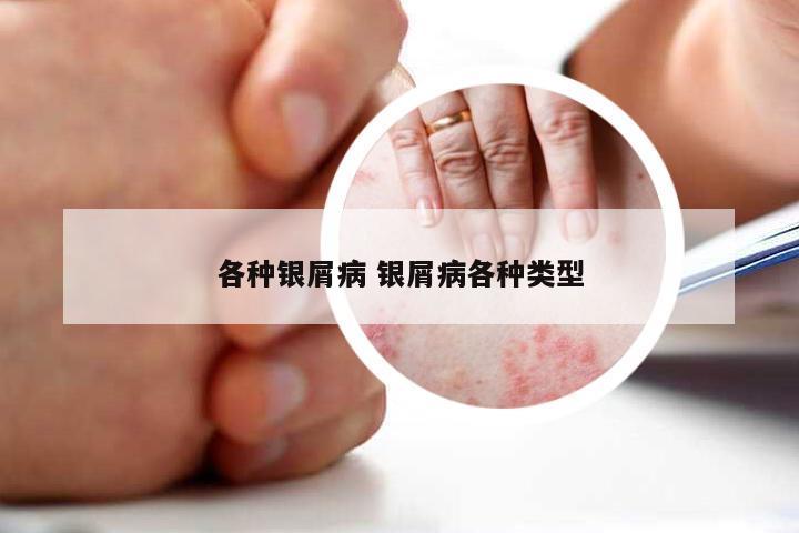 各种银屑病 银屑病各种类型