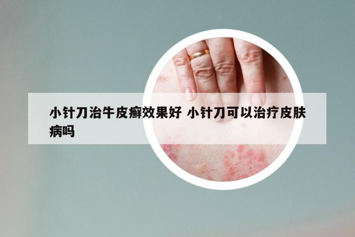 小针刀治牛皮癣效果好 小针刀可以治疗皮肤病吗