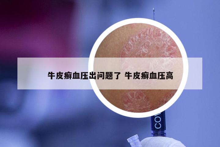 牛皮癣血压出问题了 牛皮癣血压高