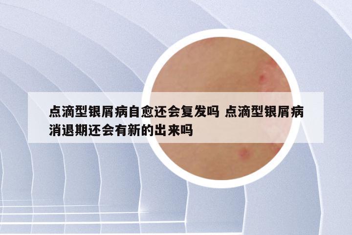 点滴型银屑病自愈还会复发吗 点滴型银屑病消退期还会有新的出来吗