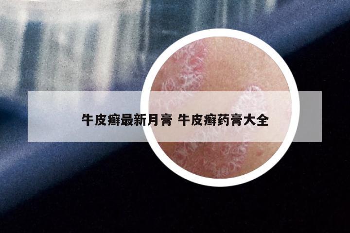牛皮癣最新月膏 牛皮癣药膏大全