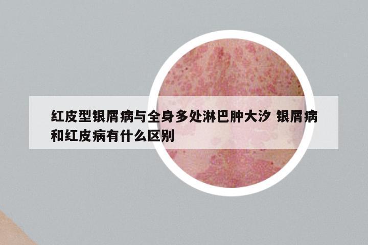 红皮型银屑病与全身多处淋巴肿大汐 银屑病和红皮病有什么区别