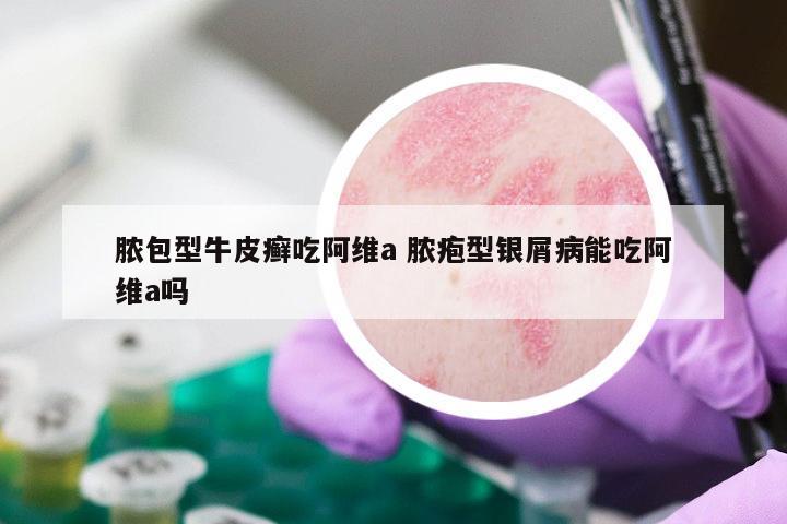 脓包型牛皮癣吃阿维a 脓疱型银屑病能吃阿维a吗
