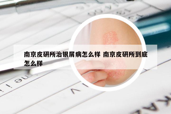 南京皮研所治银屑病怎么样 南京皮研所到底怎么样