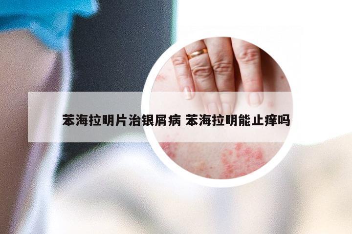 苯海拉明片治银屑病 苯海拉明能止痒吗