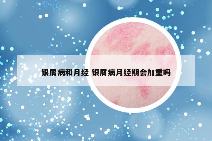 银屑病和月经 银屑病月经期会加重吗