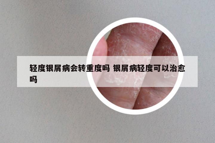 轻度银屑病会转重度吗 银屑病轻度可以治愈吗