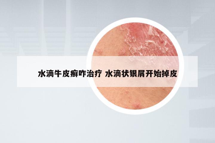 水滴牛皮癣咋治疗 水滴状银屑开始掉皮