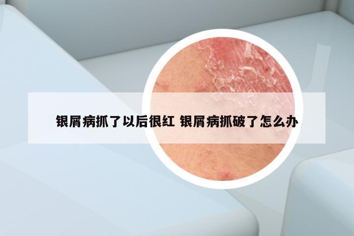 银屑病抓了以后很红 银屑病抓破了怎么办