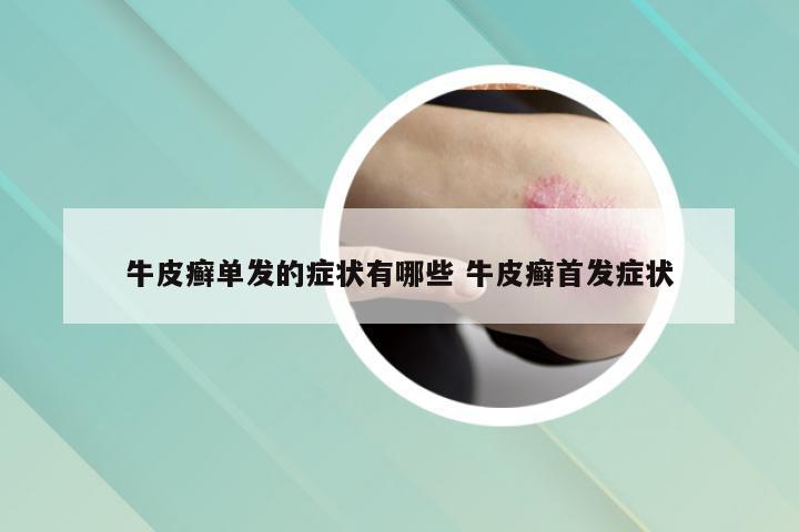 牛皮癣单发的症状有哪些 牛皮癣首发症状