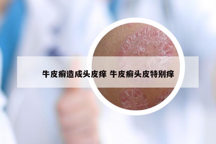 牛皮癣造成头皮痒 牛皮癣头皮特别痒