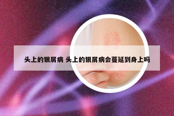 头上的银屑病 头上的银屑病会蔓延到身上吗