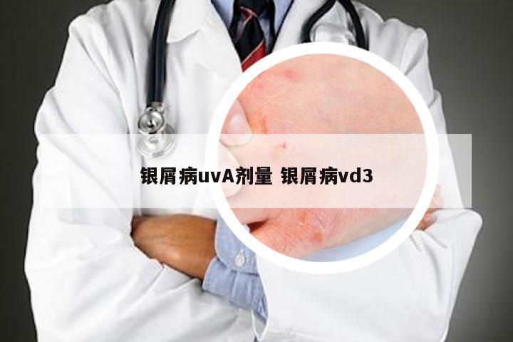 银屑病uvA剂量 银屑病vd3