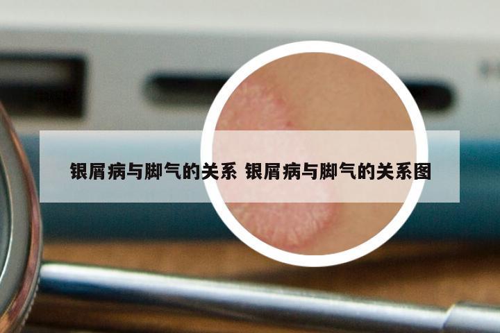 银屑病与脚气的关系 银屑病与脚气的关系图