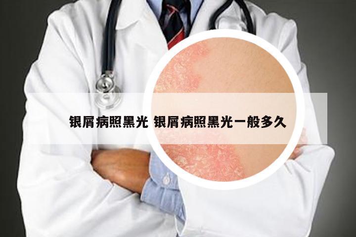 银屑病照黑光 银屑病照黑光一般多久