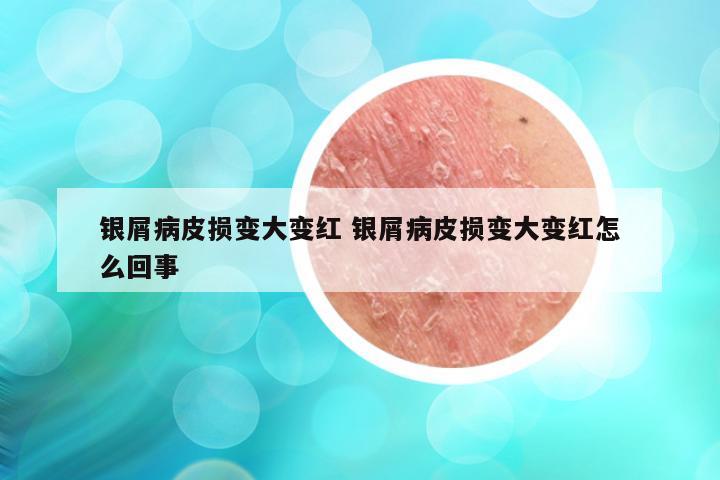 银屑病皮损变大变红 银屑病皮损变大变红怎么回事
