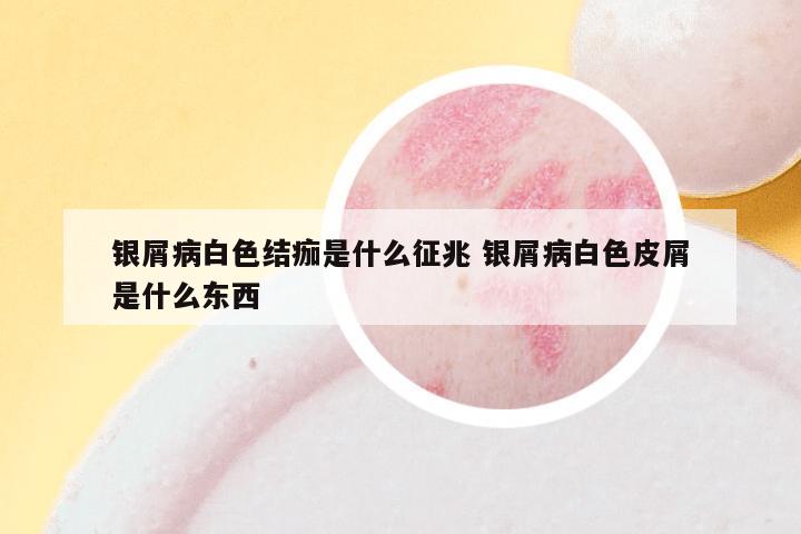 银屑病白色结痂是什么征兆 银屑病白色皮屑是什么东西