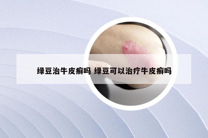 绿豆治牛皮癣吗 绿豆可以治疗牛皮癣吗