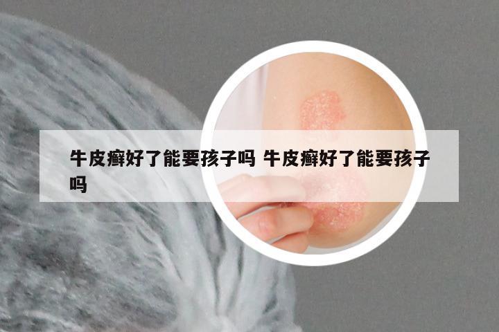 牛皮癣好了能要孩子吗 牛皮癣好了能要孩子吗