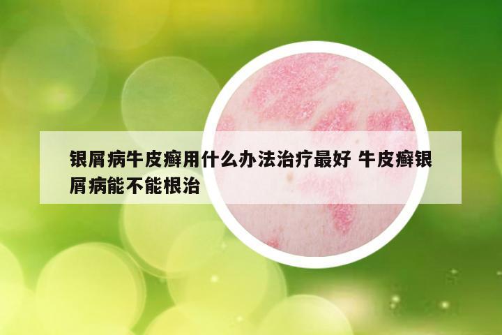 银屑病牛皮癣用什么办法治疗最好 牛皮癣银屑病能不能根治