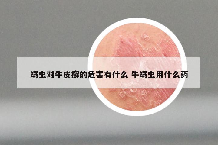 螨虫对牛皮癣的危害有什么 牛螨虫用什么药