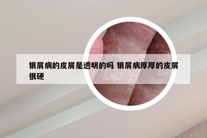 银屑病的皮屑是透明的吗 银屑病厚厚的皮屑很硬