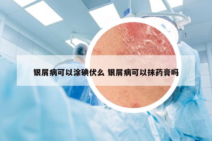 银屑病可以涂碘伏么 银屑病可以抹药膏吗