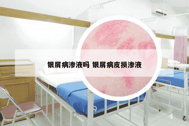银屑病渗液吗 银屑病皮损渗液