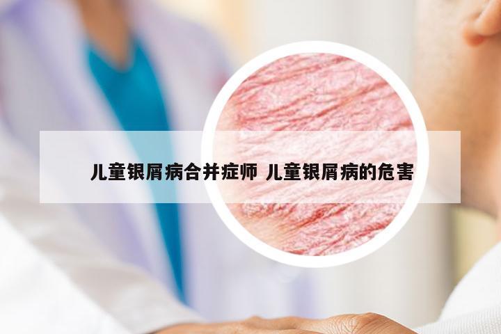 儿童银屑病合并症师 儿童银屑病的危害