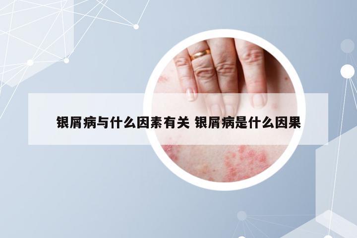 银屑病与什么因素有关 银屑病是什么因果
