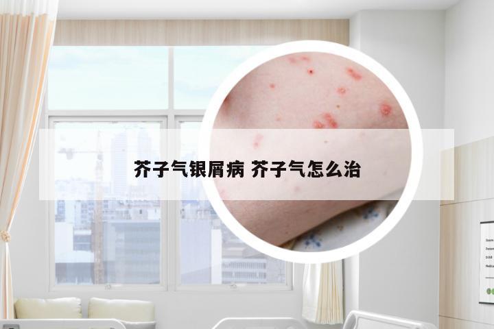 芥子气银屑病 芥子气怎么治