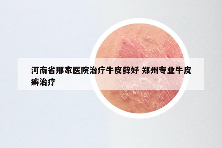 河南省那家医院治疗牛皮藓好 郑州专业牛皮癣治疗