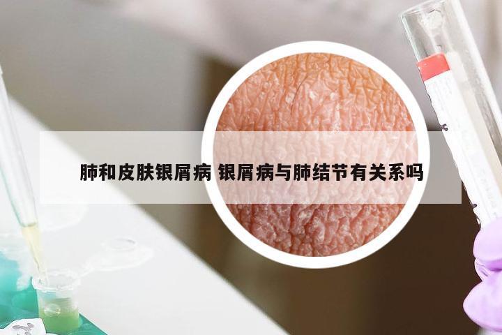 肺和皮肤银屑病 银屑病与肺结节有关系吗