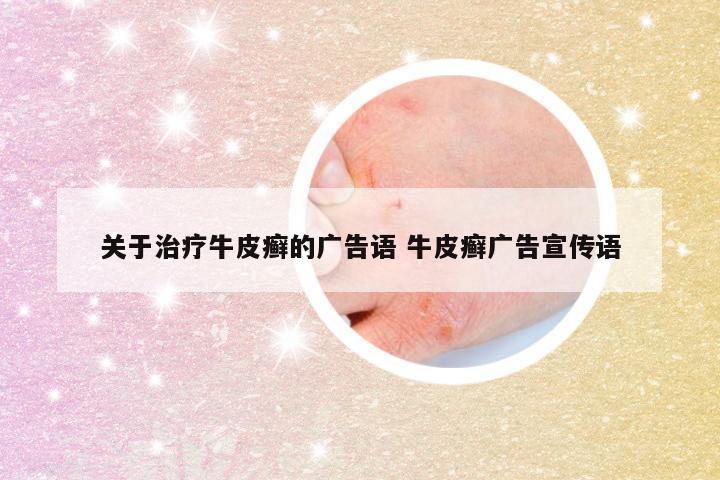关于治疗牛皮癣的广告语 牛皮癣广告宣传语