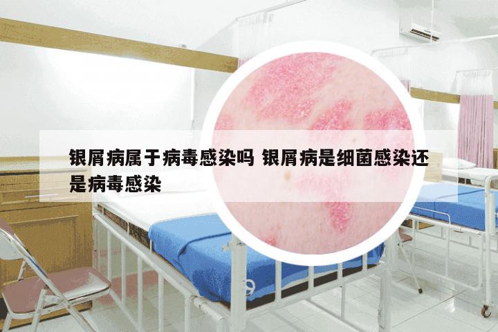 银屑病属于病毒感染吗 银屑病是细菌感染还是病毒感染