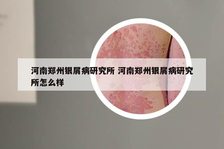 河南郑州银屑病研究所 河南郑州银屑病研究所怎么样
