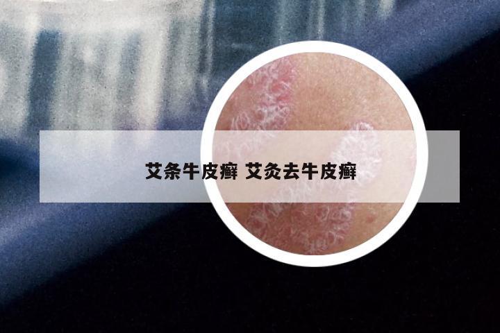 艾条牛皮癣 艾灸去牛皮癣