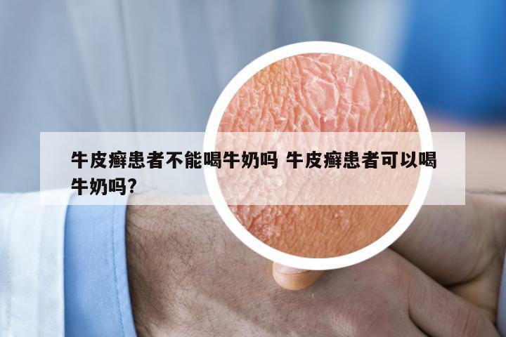 牛皮癣患者不能喝牛奶吗 牛皮癣患者可以喝牛奶吗?