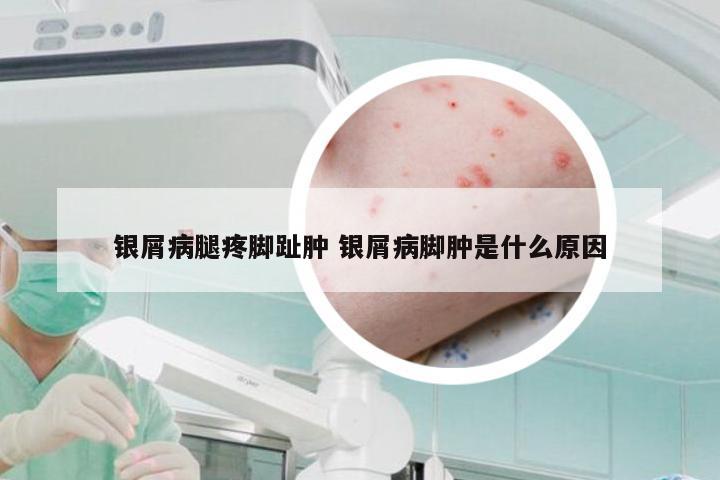 银屑病腿疼脚趾肿 银屑病脚肿是什么原因