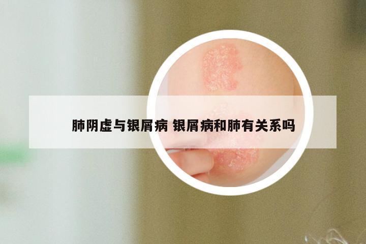 肺阴虚与银屑病 银屑病和肺有关系吗