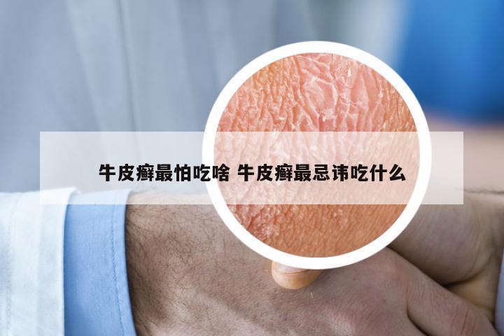 牛皮癣最怕吃啥 牛皮癣最忌讳吃什么