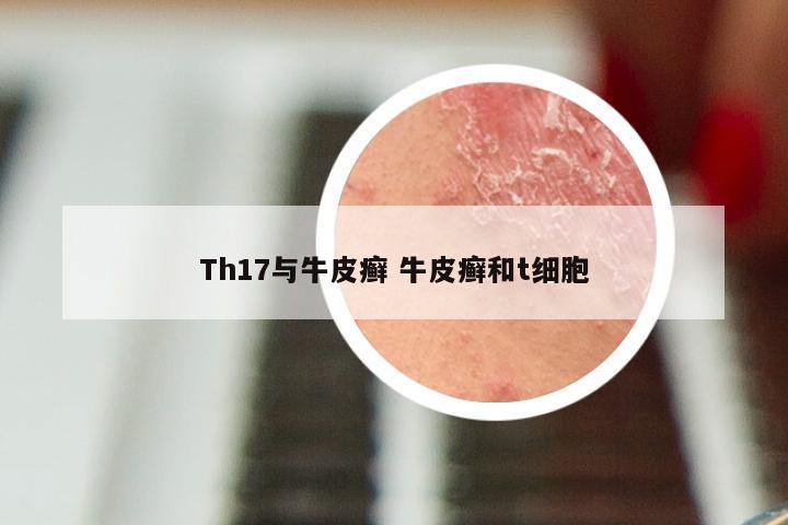 Th17与牛皮癣 牛皮癣和t细胞